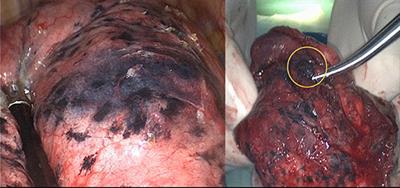 Electromagnetic Navigation Bronchoscopy in Hybrid Theater